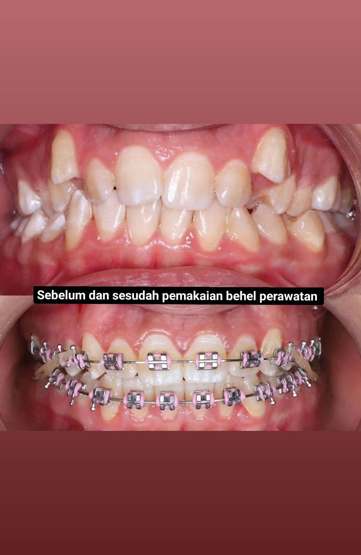 BEHEL PERAWATAN