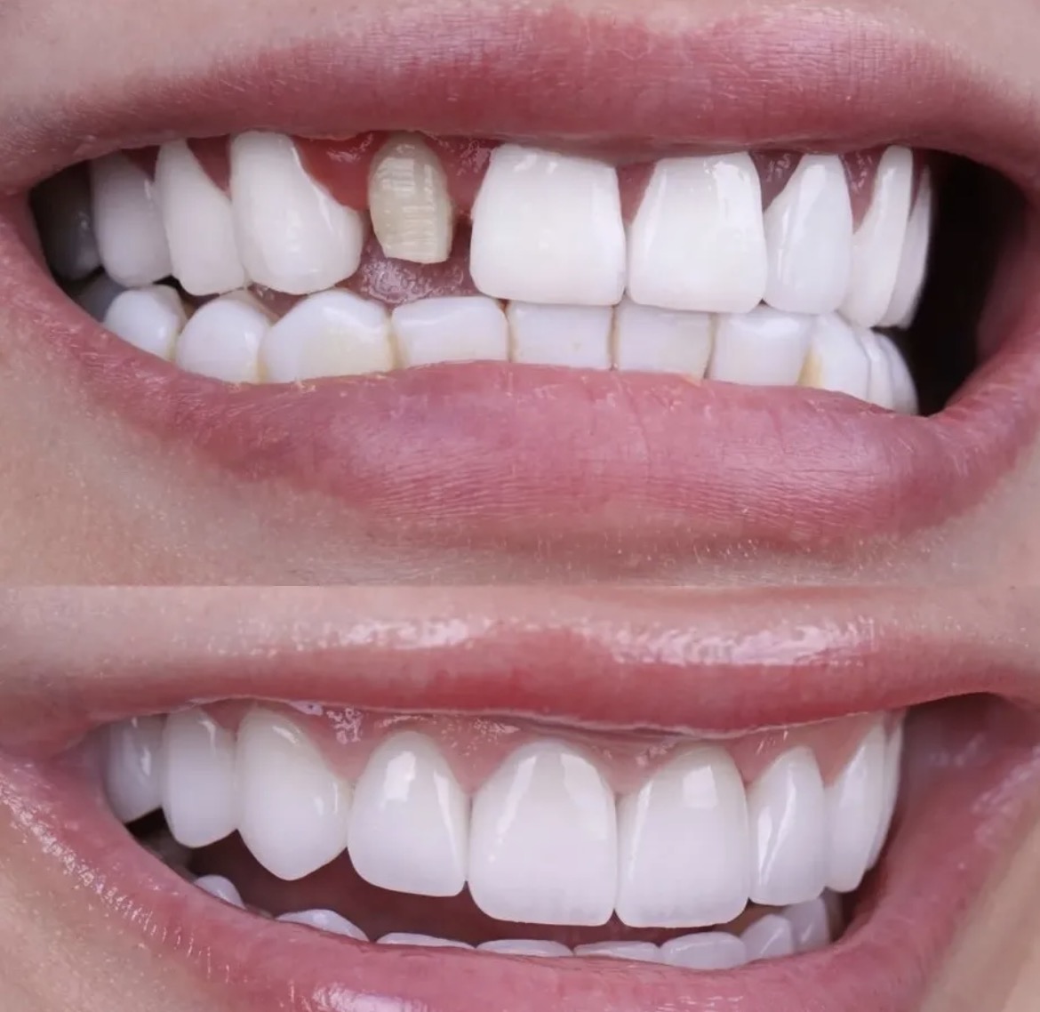 VENEER GIGI