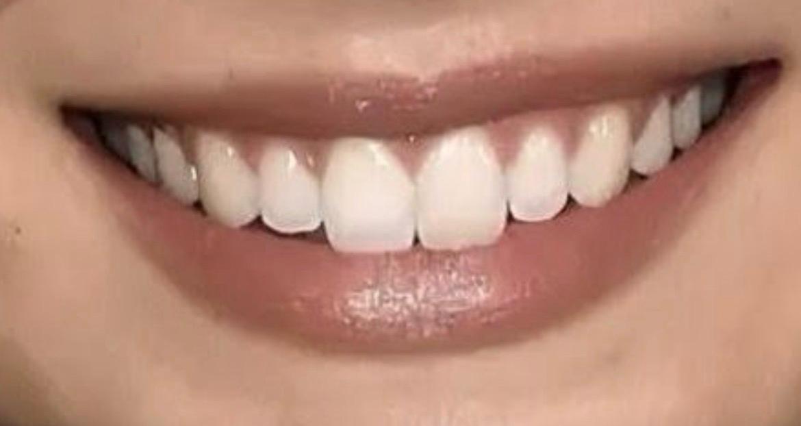 GIGI KELINCI/BUNNY TEETH