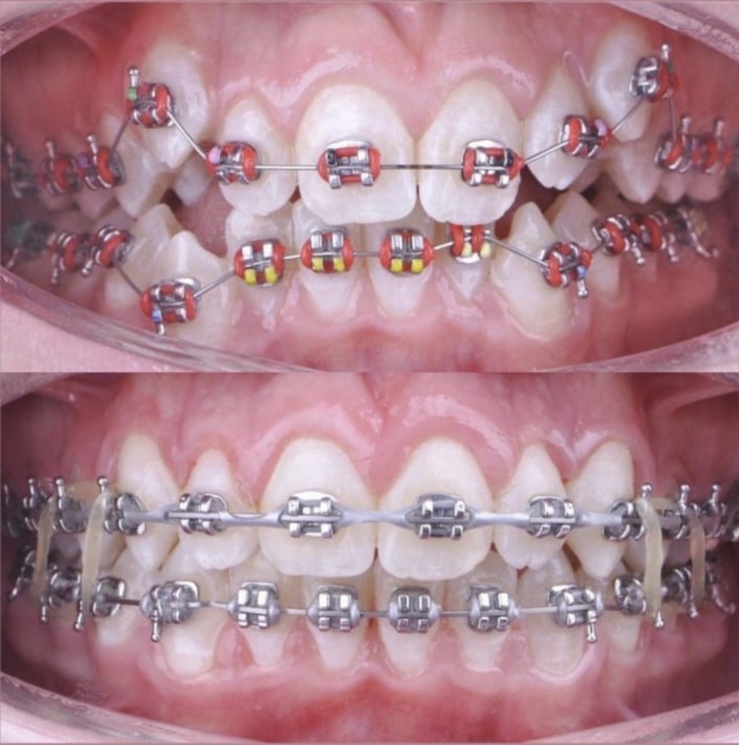 BEHEL PERAWATAN METAL ROTH